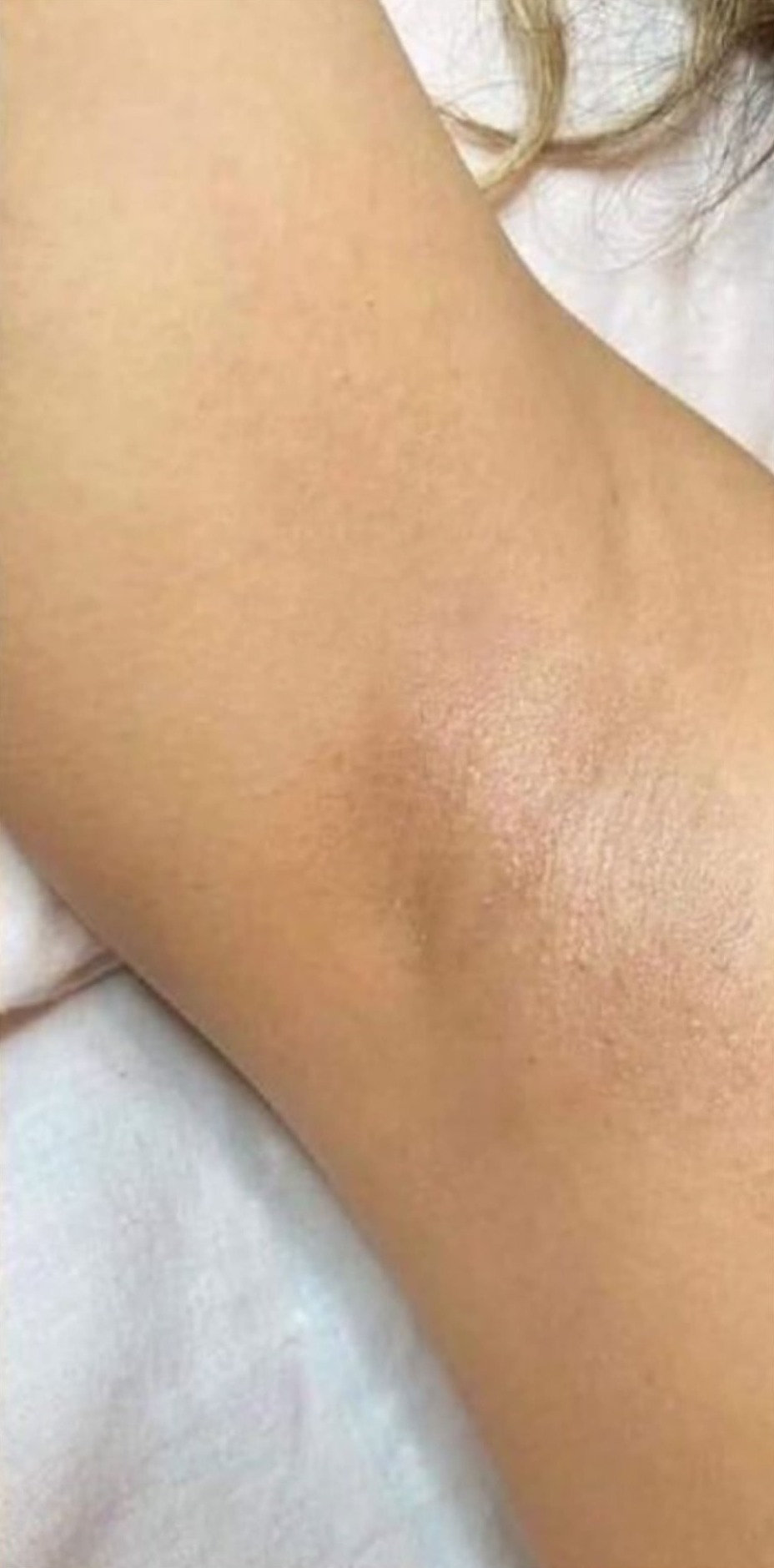 La misma zona axilar después del tratamiento láser: piel lisa sin vello