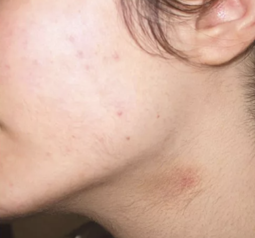 La misma zona de rostro y cuello después del tratamiento láser: sin vello visible