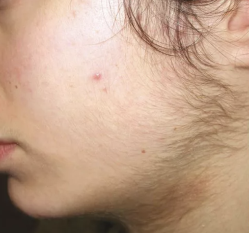 Zona de rostro y cuello antes de la depilación láser: vello oscuro visible en la mejilla y la línea mandibular