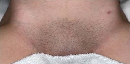 Zona bikini antes de la depilación láser: vello oscuro y denso