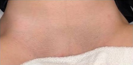 La misma zona bikini después del tratamiento láser: piel lisa y sin vello